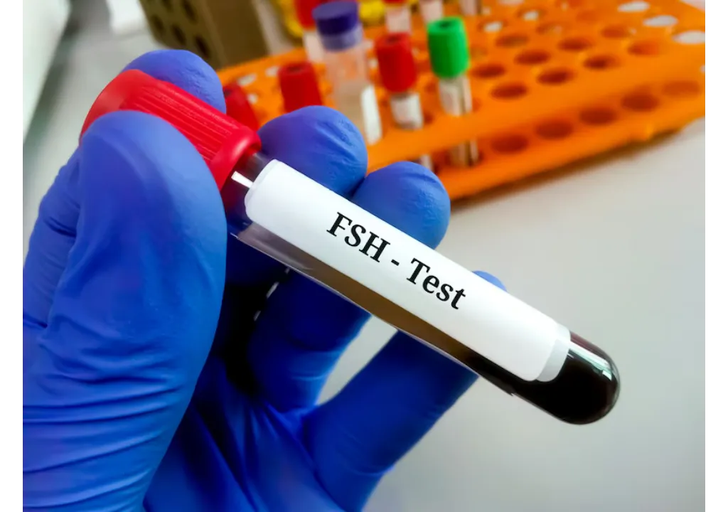 FSH Follicle Stimulating Hormone Test